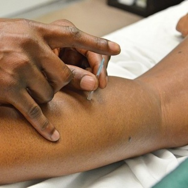 Acupuncture Treatment needle on a patient's arm.